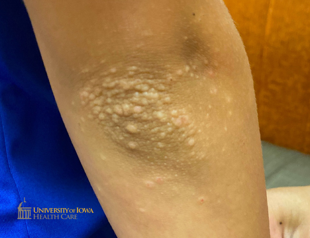 Hypopigmented flat-topped papules on the elbow. (click images for higher resolution).